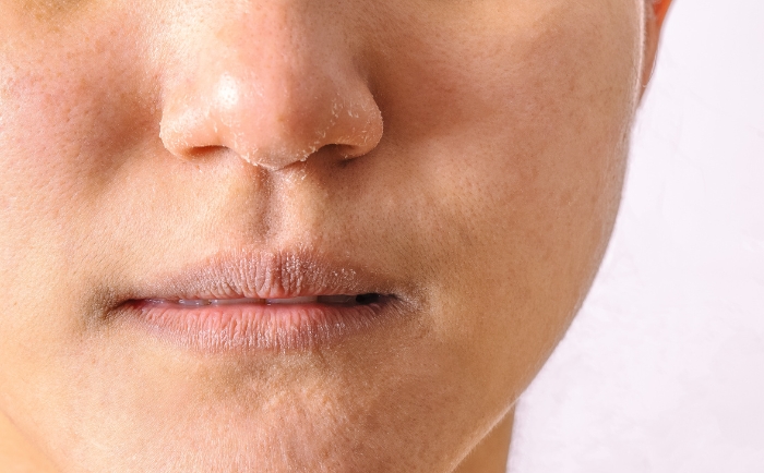 bariera hydrolipidowa